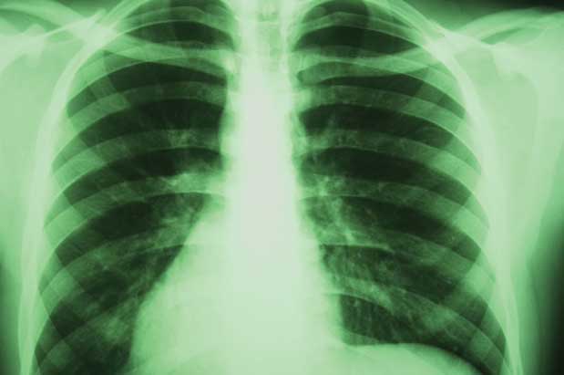 New Treatment: Rib Plate